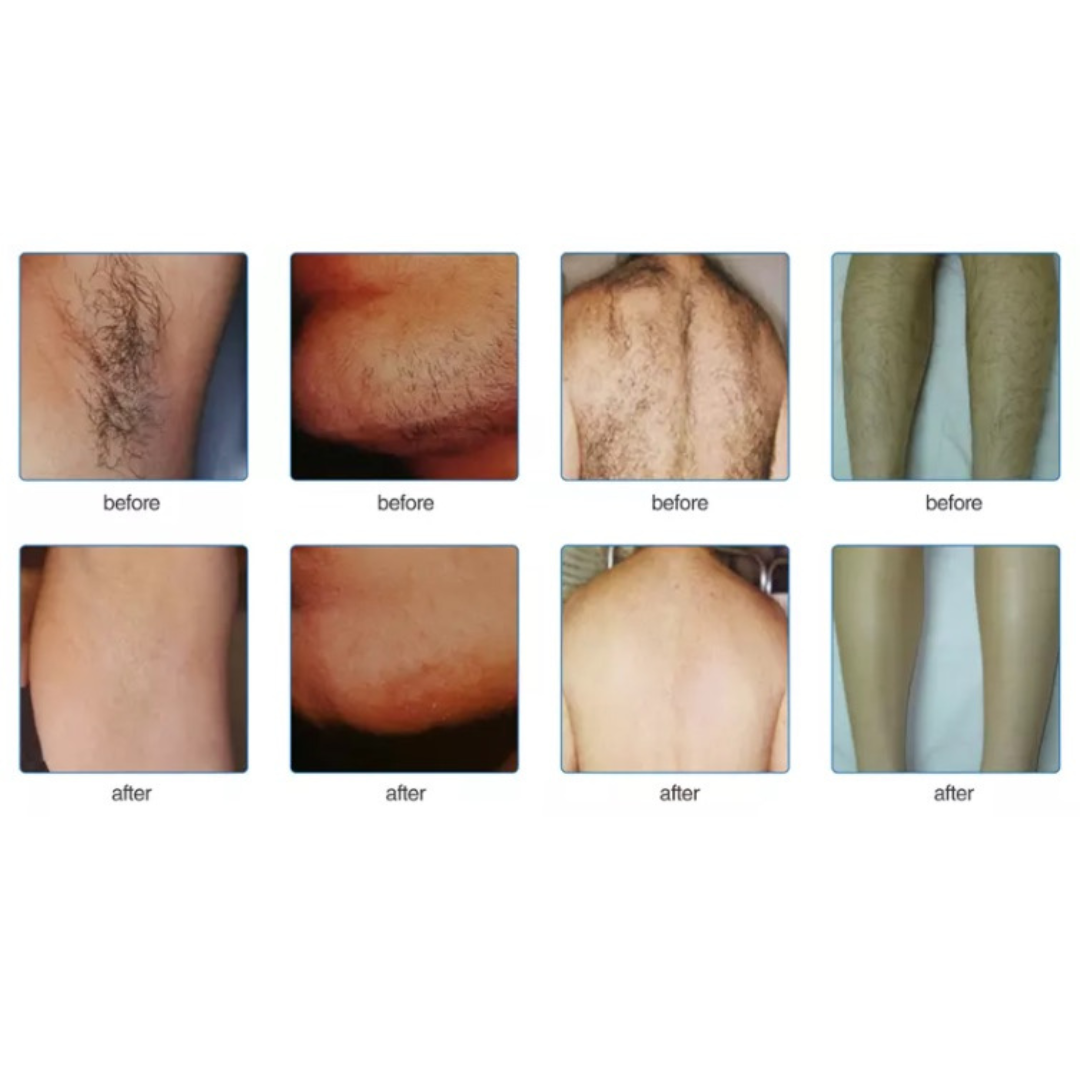 Before and after IPL hair removal treatment on Underarms, chin back, legs