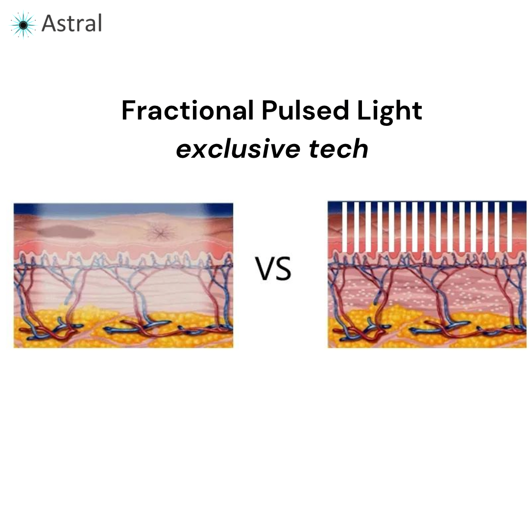 APEX™ 10D All-in-One Intense Pulsed Light System