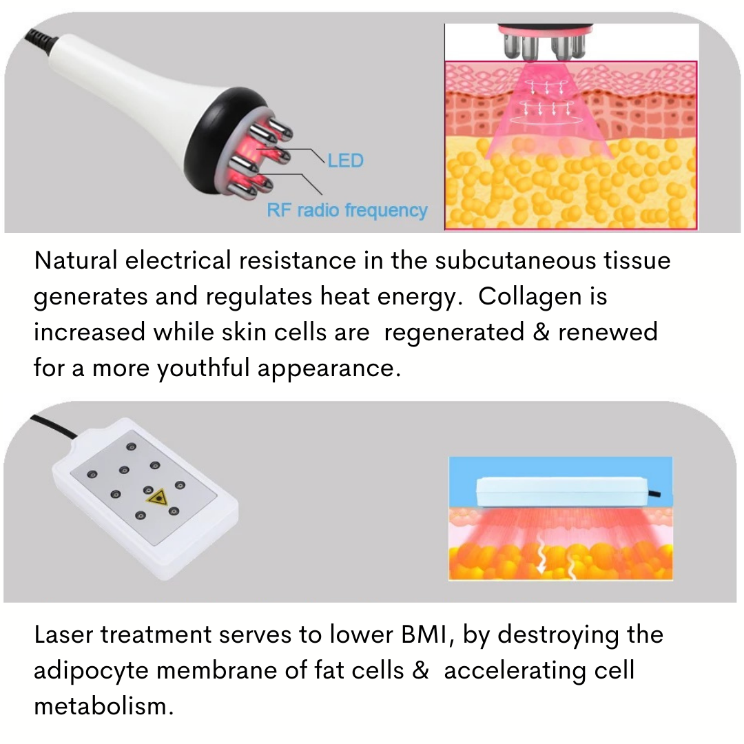 RF treatment